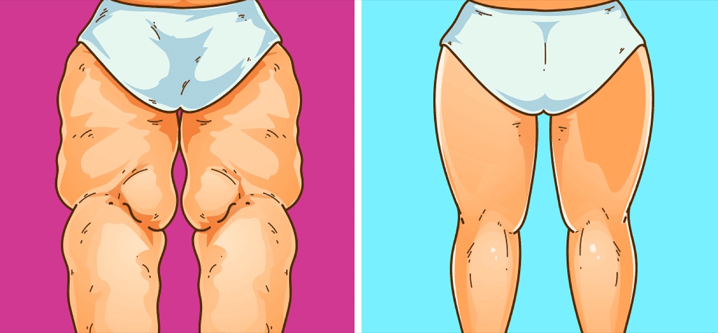 Os possíveis tratamentos para o lipedema